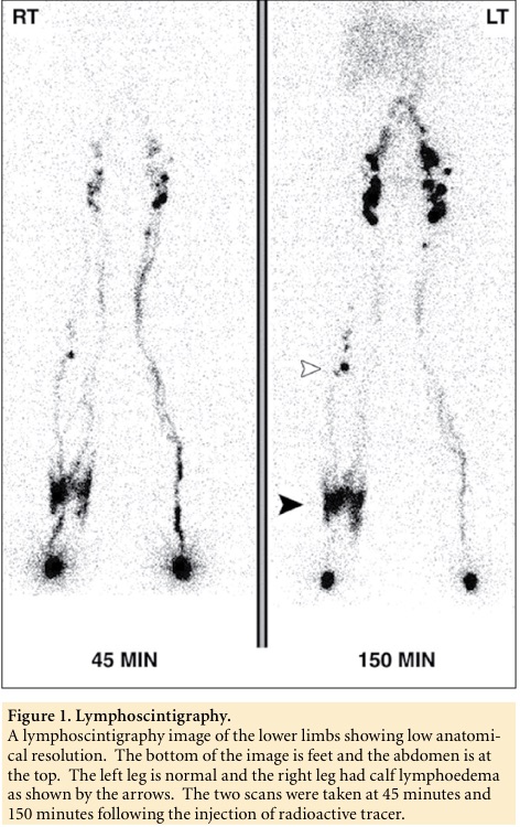 Figure 1. Lymphoscintigraphy