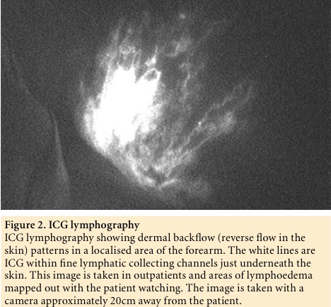 Figure 2. ICG lymphography
