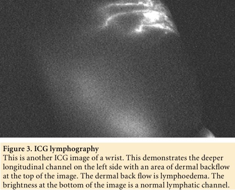 Figure 3. ICG lymphography