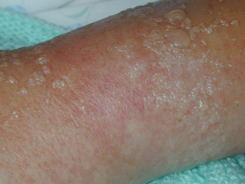 Lymphorrhoea
