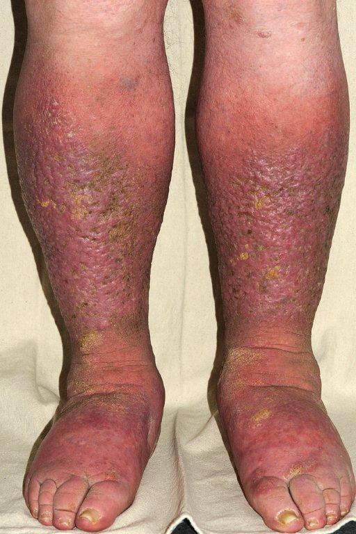 Fig. 1 Red Legs
